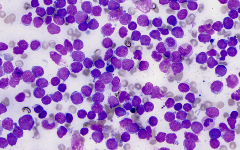 Acute Lymphoblastic Leukaemia