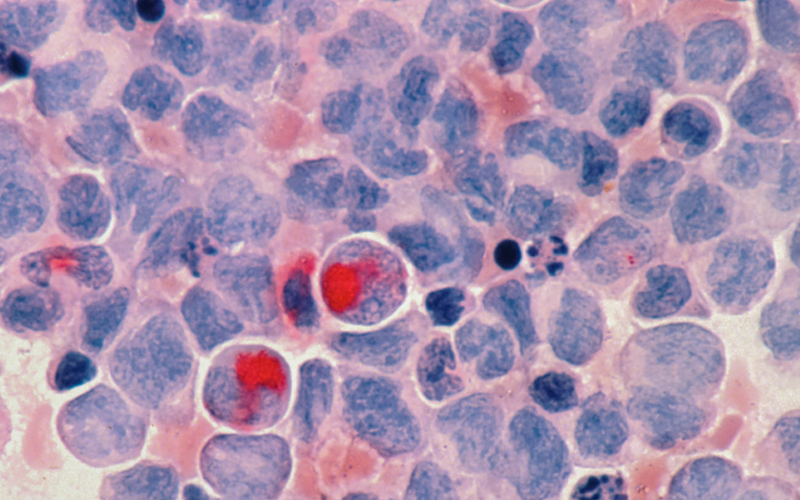 Acute Myeloid Leukaemia