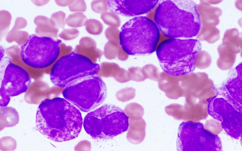 Acute Promyelocytic Leukemia