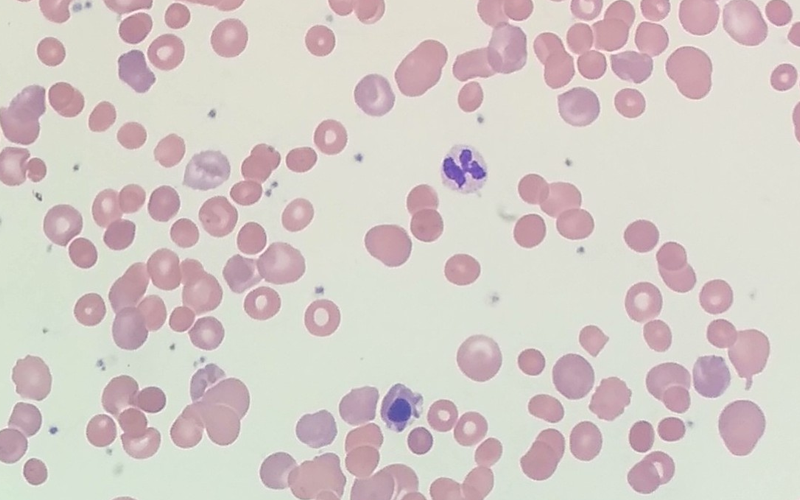 Autoimmune Hemolytic Anemia