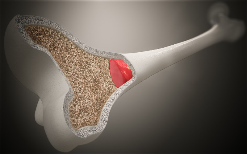 Bone Marrow Failure