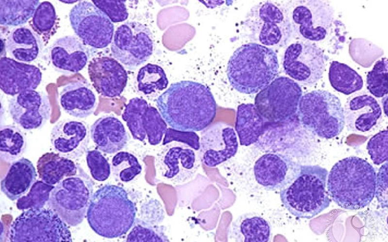 Chronic Lymphocytic Leukaemia