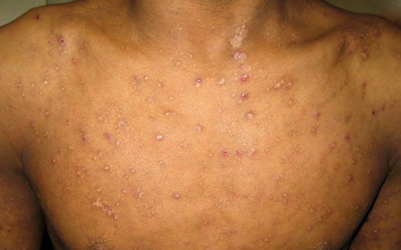 Hodgkin Lymphoma