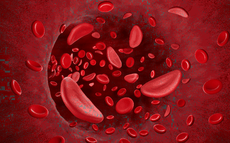 Sickle Cell Disease